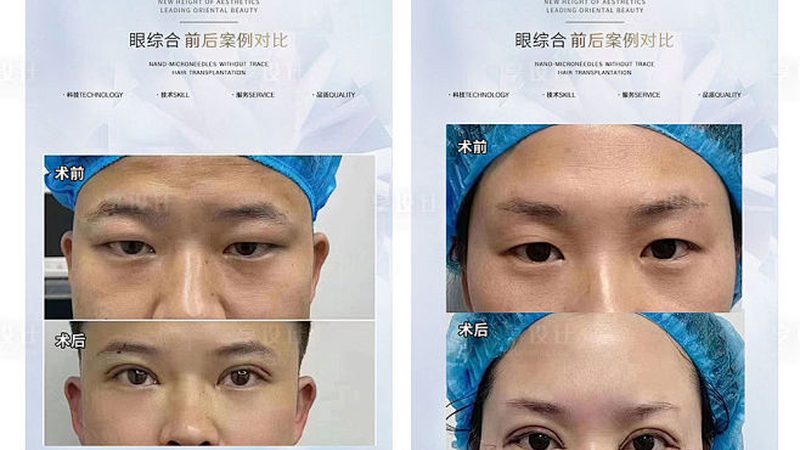 轻医美价格表：肉毒素注射的性价比解析
