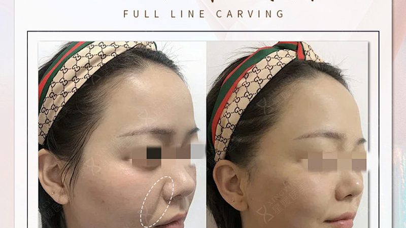 北京冰点脱毛医院推荐
