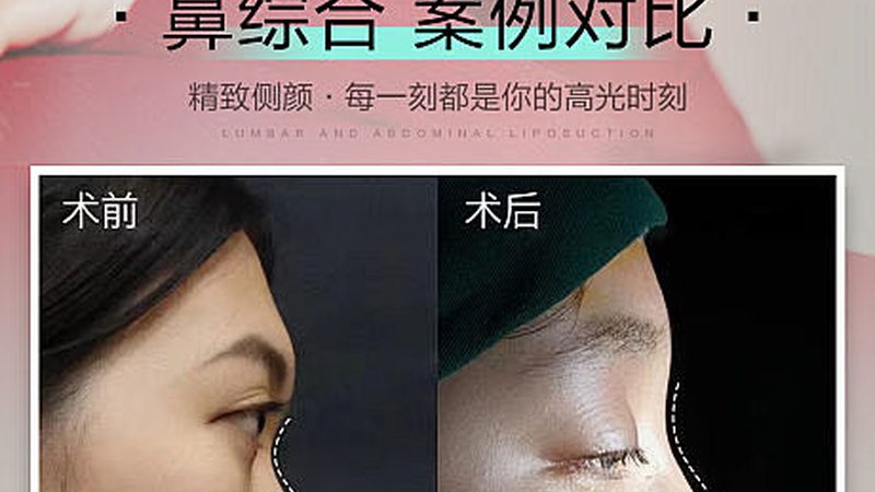 光子嫩肤美白，效果维持时间揭秘与护理攻略