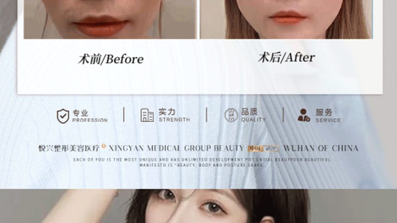 玻尿酸隆鼻：揭秘北京哪家机构技艺精湛