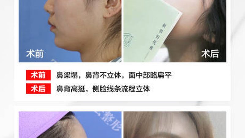 广州韩式三点双眼皮：揭秘价格背后的秘密