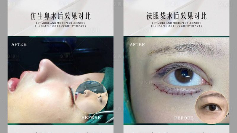 公立医院埋线提升：揭秘手术原理与选择标准