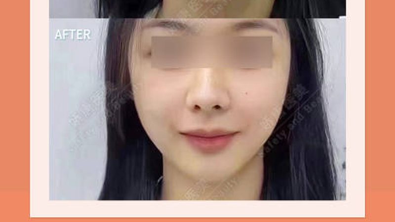 轻医美械字号产品OEM定制厂家