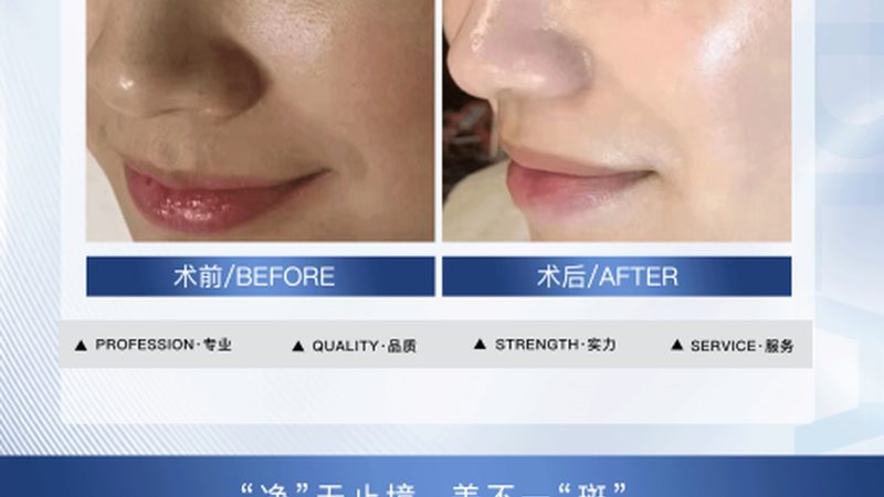 激光祛斑的效果维持时间因人而异，通常与以下因素有关：