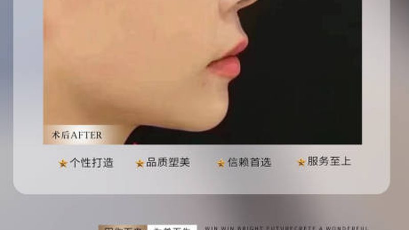 隆鼻术后恢复：揭秘全过程与关键期